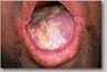 La prolifération de Candida dans la bouche