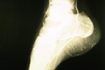 Un rayon X donne un aperçu des coulisses à os du pied dans une position de talon haut.