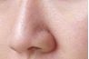 Les grands pores sont généralement présents sur les côtés d'un nez.